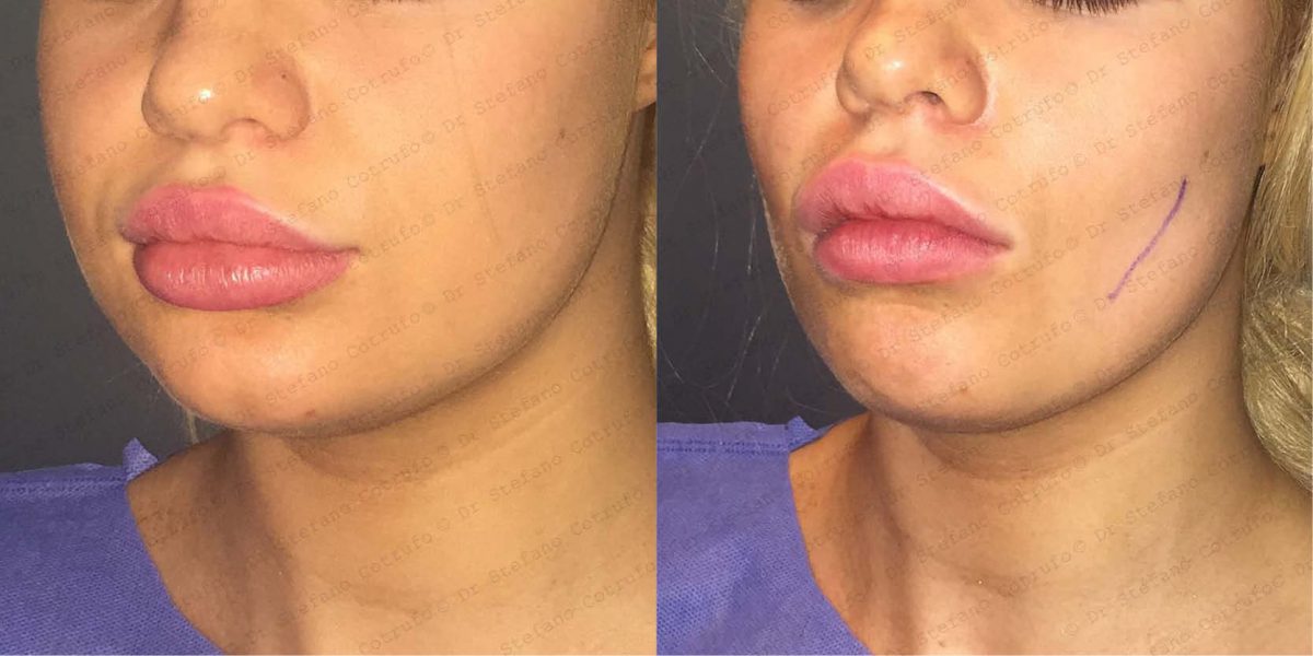 Cheek Fat Removal
