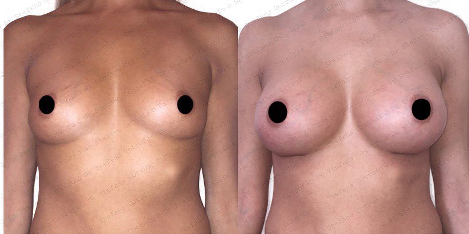 Breast Augmentation London