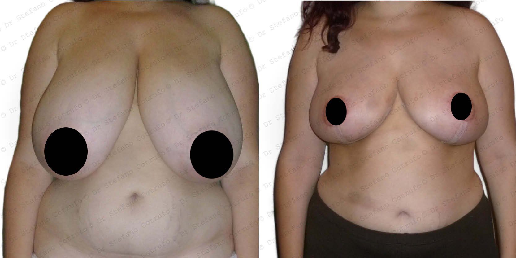 Breast Reduction London