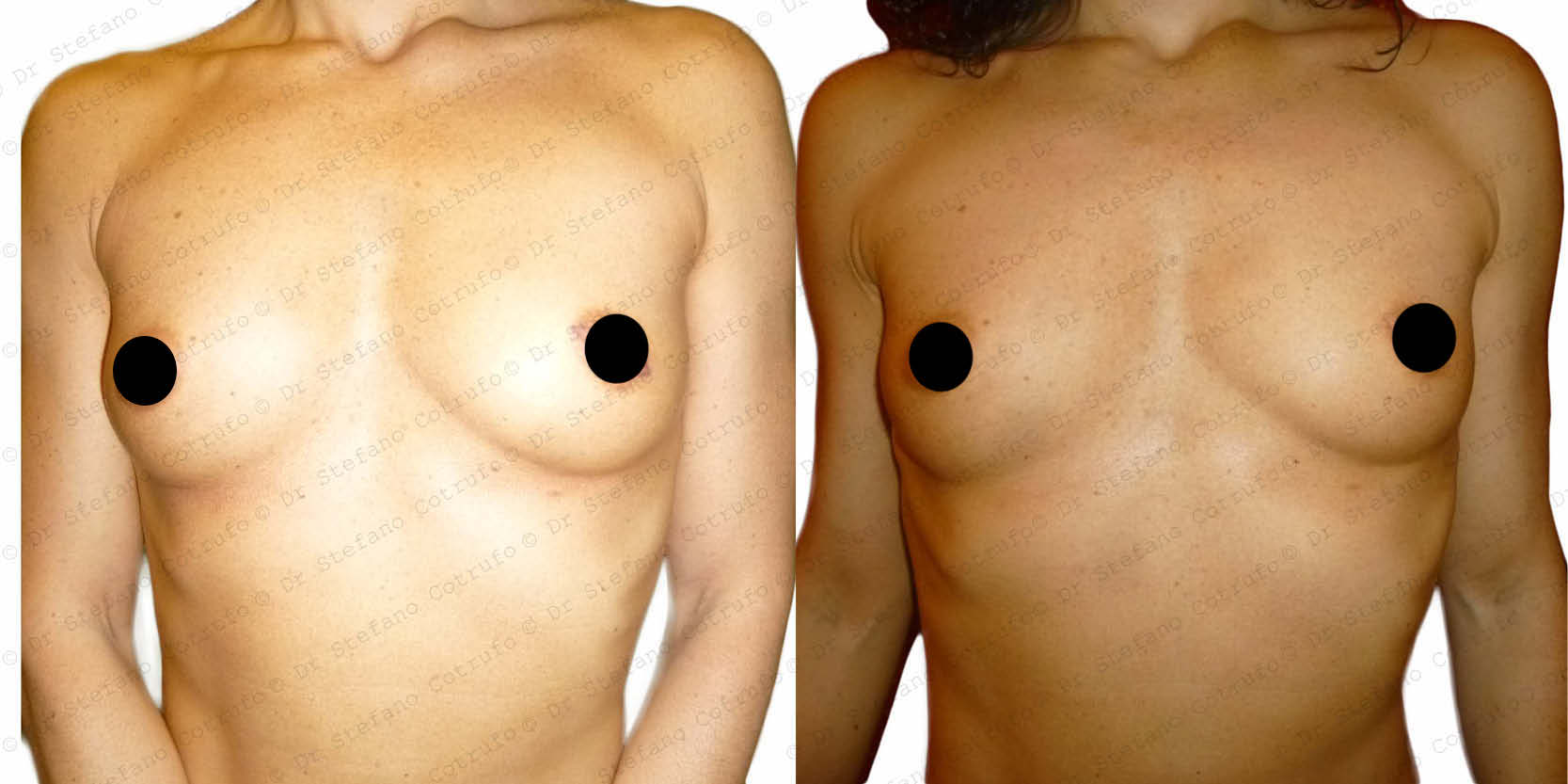Nipple Surgery London