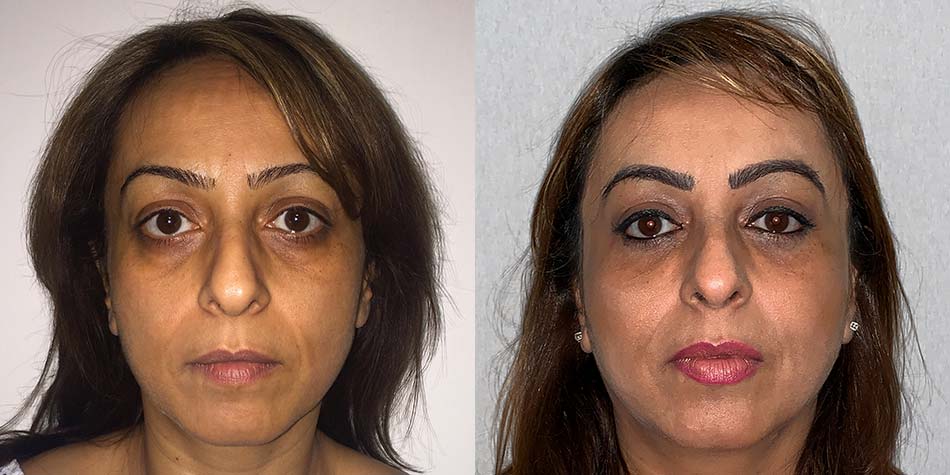 eye-lid-surgery-before-after-2-front