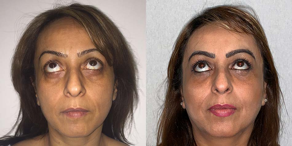 eye-lid-surgery-before-after-2