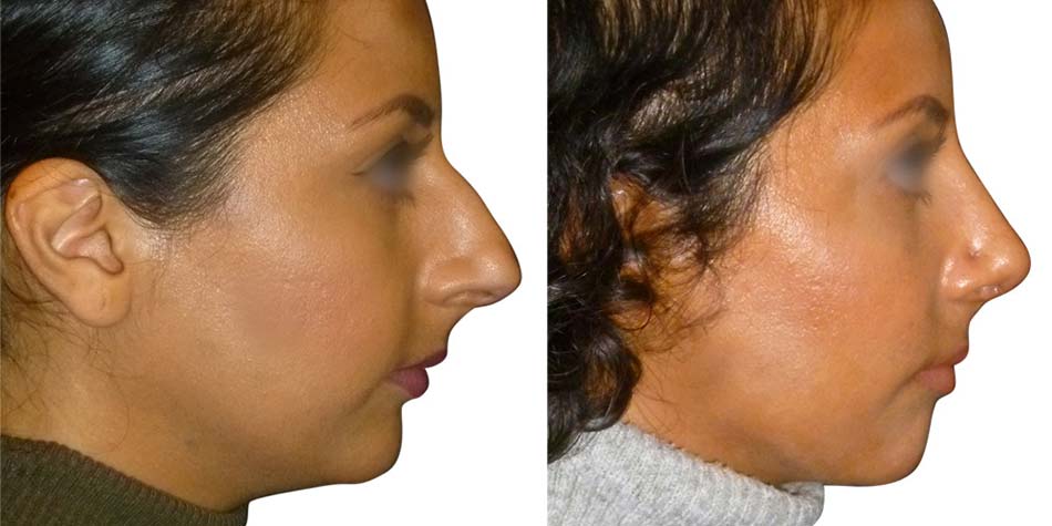 rhinoplasty-before-after-1