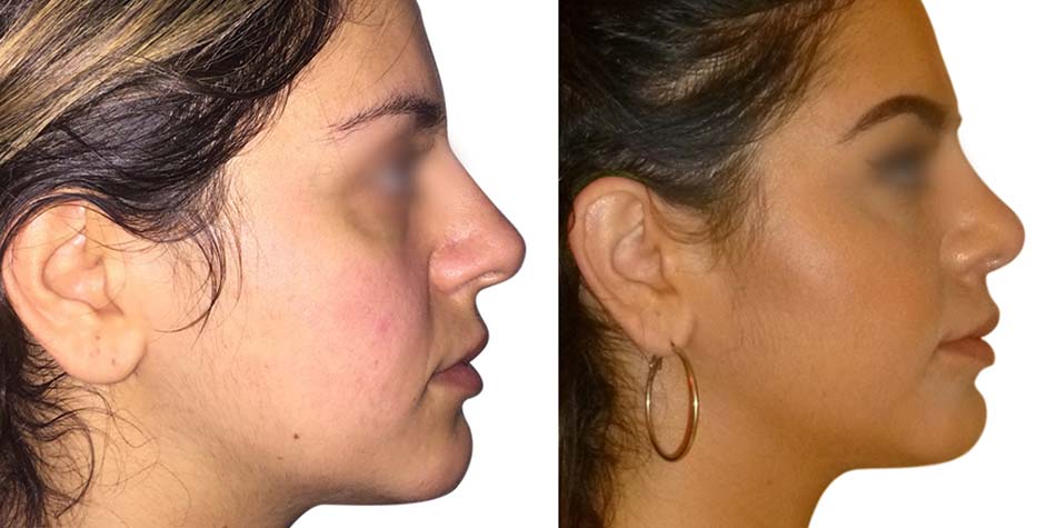 rhinoplasty-before-after-2