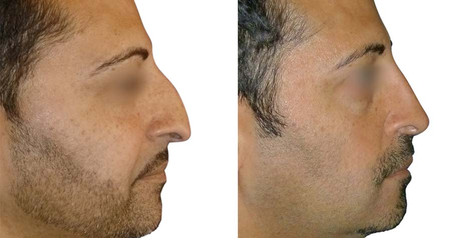 rhinoplasty-before-after-3