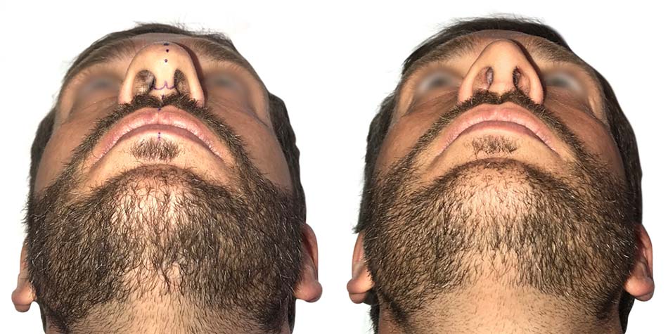 septo-rhinoplasty-before-after-1