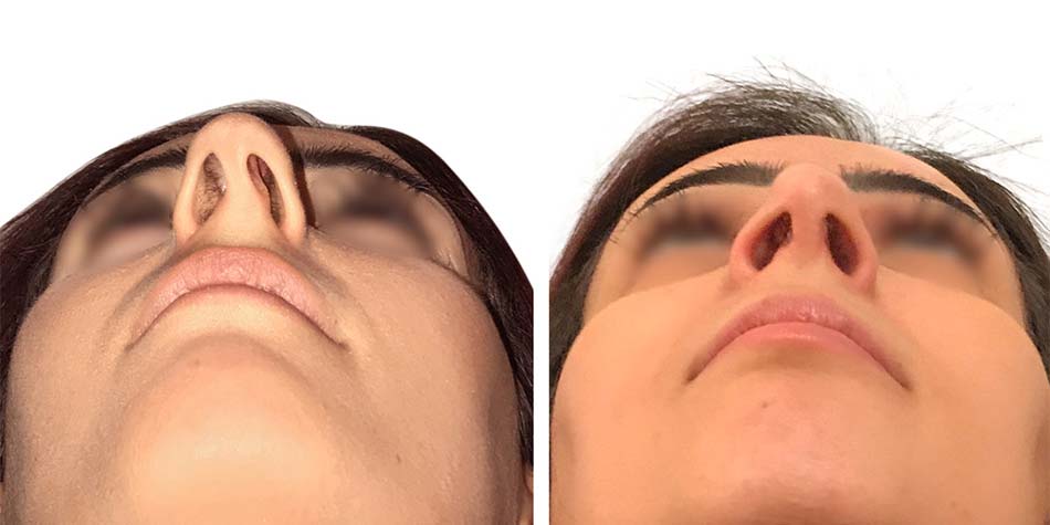 septo-rhinoplasty-before-after-2