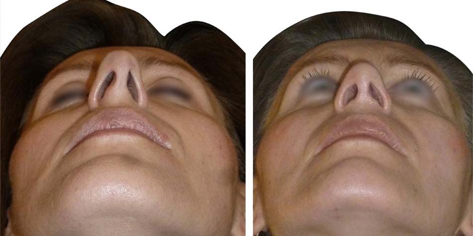 septo-rhinoplasty-before-after-3