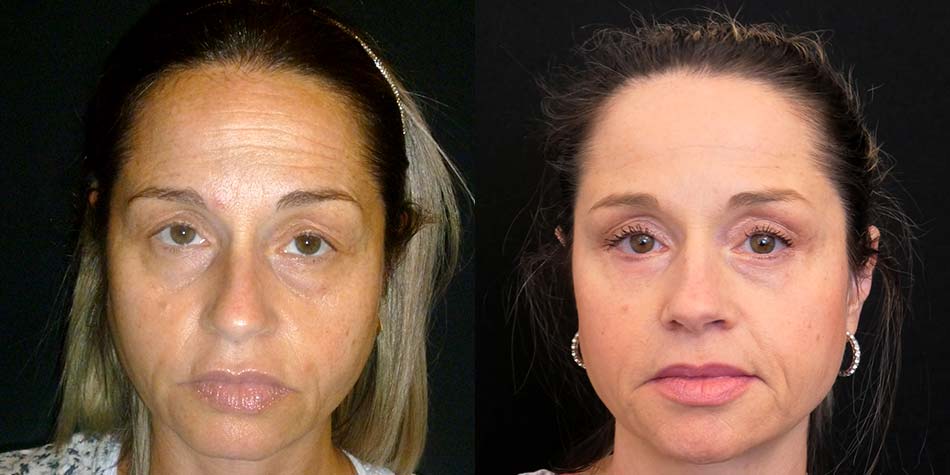eye-lid-surgery-before-after-1-front-2