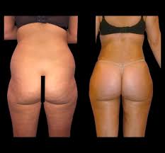Is BBL Surgery right for you? Dr Stefano Cotrufo