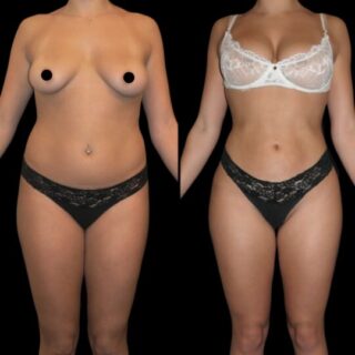 VASER. Liposuction UK results, with Dr Stefano Cotrufo.