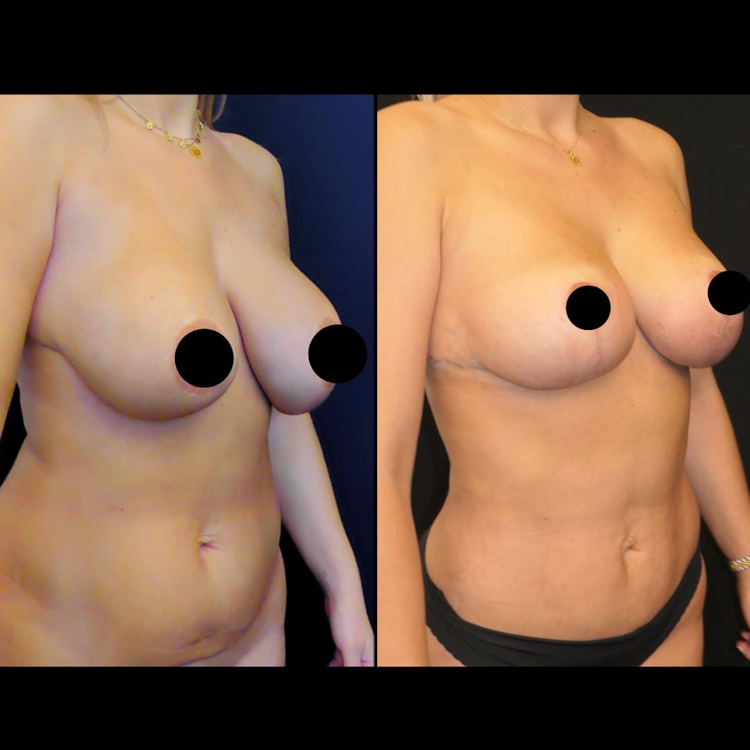 breast lift surgery