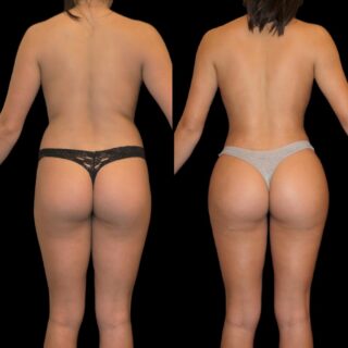 VASER Liposuction UK with Dr Stefano Cortufo