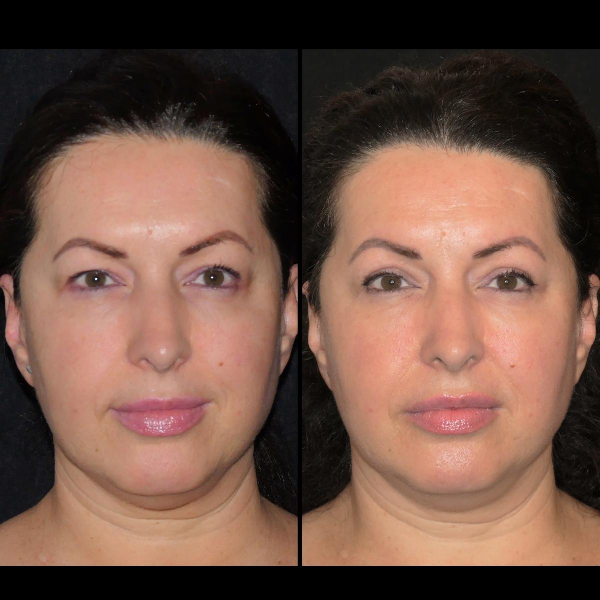 Hooded Eyelids - Upper blepharoplasty before and after, Dr Stefano Cotrufo London